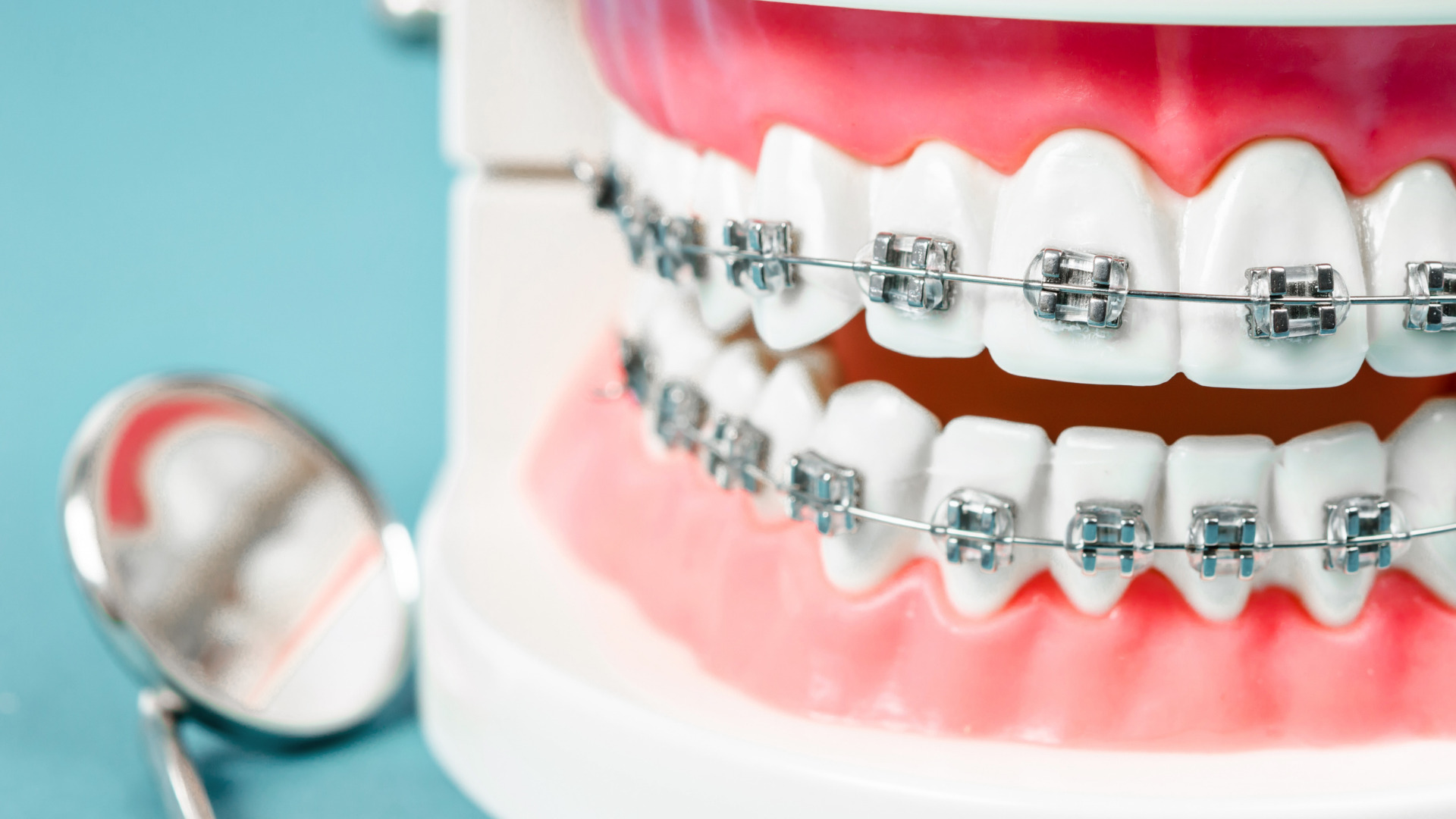 Ortodonti Diş Teli Fiyatları Nedir?