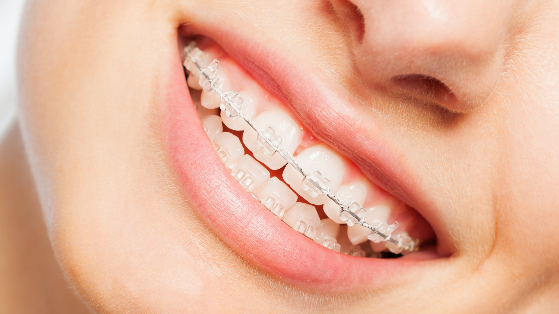 Porselen Diş Teli Nedir?