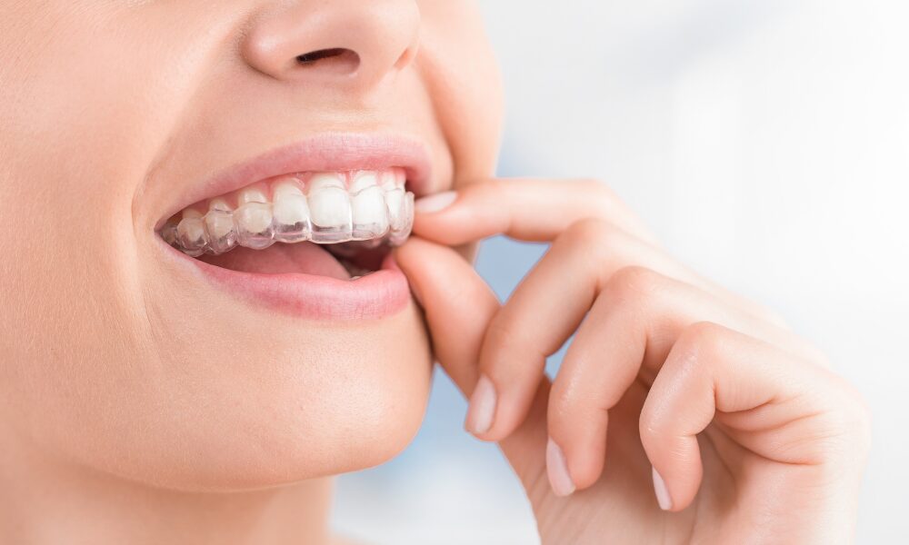 Ortodonti Plak Fiyatları İçin Etkili Olan Faktörler Nelerdir?